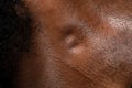 Swollen lymph nodes in the neck of an African man Royalty Free Stock Photo