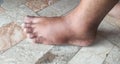 Swollen metatarsal dan ankles due to gout