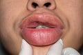 Swollen or thickened lips of Asian man. Angioedema. Filler injection complications. Causes may be allergies, infection, injury,