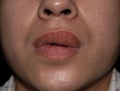 Swollen or thickened upper lip of Asian man. Angioedema. Causes may be allergies, infection, injury, etc