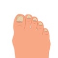 Swollen toe, onychocryptosis. Foot with nail disease or infection. Foot with onychomycosis or nail fungus.