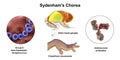 Sydenham's chorea, an autoimmune disease that results from childhood infection with Streptococcus bacteria