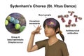 Sydenham's chorea, an autoimmune disease that results from Streptococcus infection