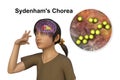 Sydenham's chorea, an autoimmune disease that results from Streptococcus infection