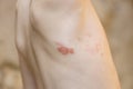 Symptom of herpes zoster shingles