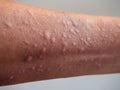 Symptoms of contact allergy on hand skin