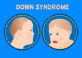 Down Syndrom Symptoms