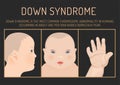 Down Syndrom Symptoms