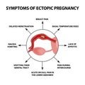 Symptoms of ectopic pregnancy. Infographics. Vector illustration on isolated background.