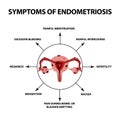 Symptoms of endometriosis. The uterus ovaries structure. Infographics. Vector illustration on isolated background