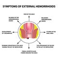 Symptoms of external hemorrhoids. The hemorrhoidal node in the rectum, anus. Infographics. Vector illustration