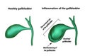 Symptoms of gallbladder inflammation. Cholecystitis.