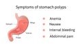 Symptoms of gastric polyps. pedunculated and flat-based polyp. Antrum. Anemia, nausea. Medical vector illustration marked with