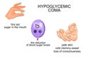 Symptoms and help with hypoglycemic coma Royalty Free Stock Photo