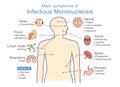 Symptoms Of Infectious Mononucleosis Disease.