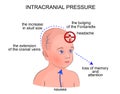 The symptoms of intracranial pressure in children Royalty Free Stock Photo