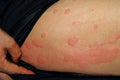 Urticaria rash Royalty Free Stock Photo