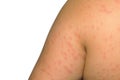 Symptoms of itchy urticaria.