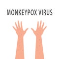 Symptoms of monkeypox