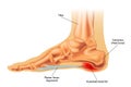 Symptoms of plantar fasciitis