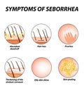 Symptoms of seborrhea. Seborrhea skin and hair. Dandruff, seborrheic dermatitis. Baldness, hair growth, baldness Royalty Free Stock Photo