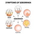 Symptoms of seborrhea. Seborrhea skin and hair. Dandruff, seborrheic dermatitis. Baldness, hair growth, baldness