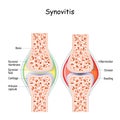 Synovitis. Close-up healthy joint and a joint with inflammation of the synovial membrane.