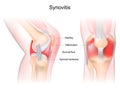 Synovitis of a Knee. Frontal and side view of human knee joint