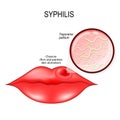 Syphilis. Human lips with chancre. Treponema pallidum Royalty Free Stock Photo