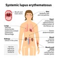 Systemic lupus erythematosu Royalty Free Stock Photo