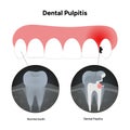 Hand-drawn dental infographic dental pulpitis with X-ray Royalty Free Stock Photo