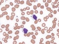 T-cell large granular lymphocytic leukemia.