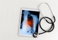 Tablet with an x-ray of a lung and a stethoscope Royalty Free Stock Photo