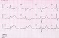 Tape ECG with acute period of myocardial infarction