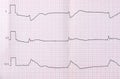 Tape ECG after clinical death and successful resuscitation