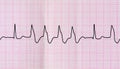 Tape ECG with group ventricular extrasystoles