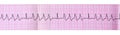 Tape ECG with group ventricular extrasystoles