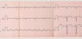 Tape ECG with paroxysm of atrial flutter Royalty Free Stock Photo
