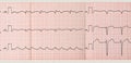 Tape ECG with paroxysm of atrial flutter