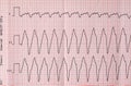 Tape ECG with paroxysm correct form of atrial flutter Royalty Free Stock Photo