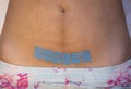 Taping a kinesiology tape on a scar after a caesarean section.