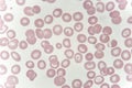 Target cells with abnormal red blood cells from anemia patient Royalty Free Stock Photo