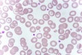 Target cells with abnormal red blood cells from anemia patient Royalty Free Stock Photo