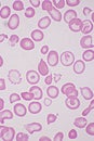 Target cells with abnormal red blood cells