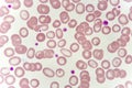 Target cells with abnormal red blood cells from anemia patient