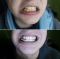 Tartar removal. Before and after the procedure for cleaning the tooth enamel from plaque and yellowness. Deposition of microbial Royalty Free Stock Photo