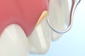 tartar removal tool removing and dental calculus