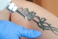 Tattoo removal Royalty Free Stock Photo