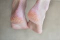 Close up cracked heels. Health problems with skin on feet Royalty Free Stock Photo