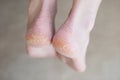 Close up cracked heels. Health problems with skin on feet Royalty Free Stock Photo